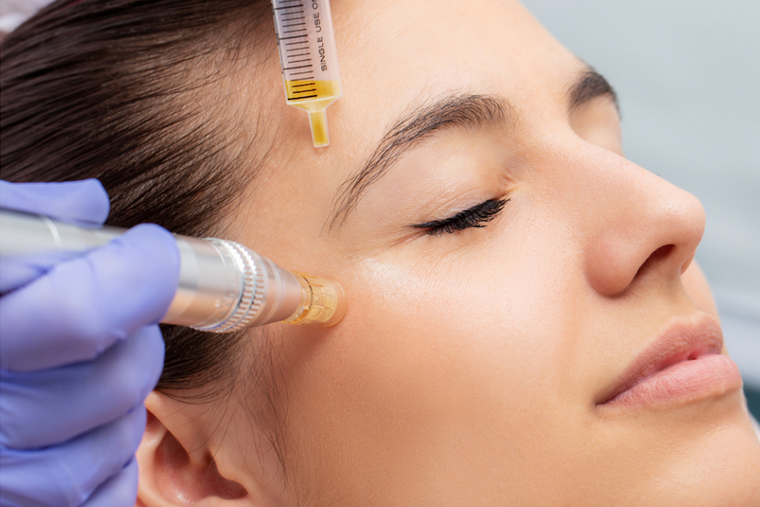 Micro Needling 02