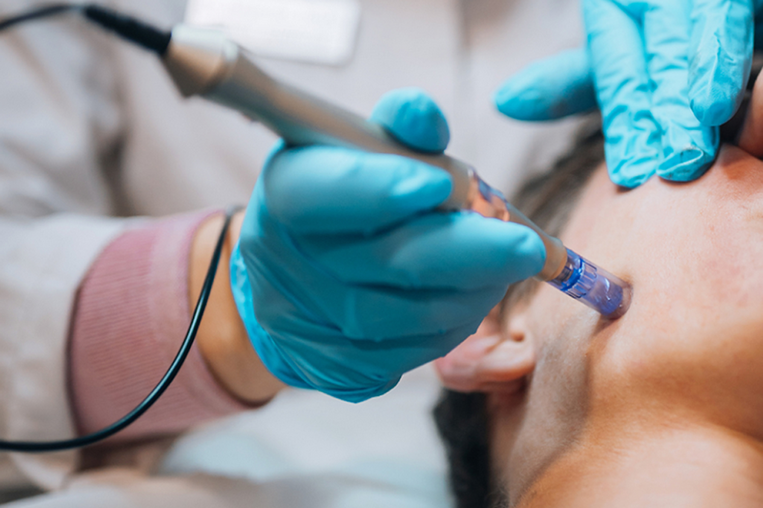 Micro Needling 03