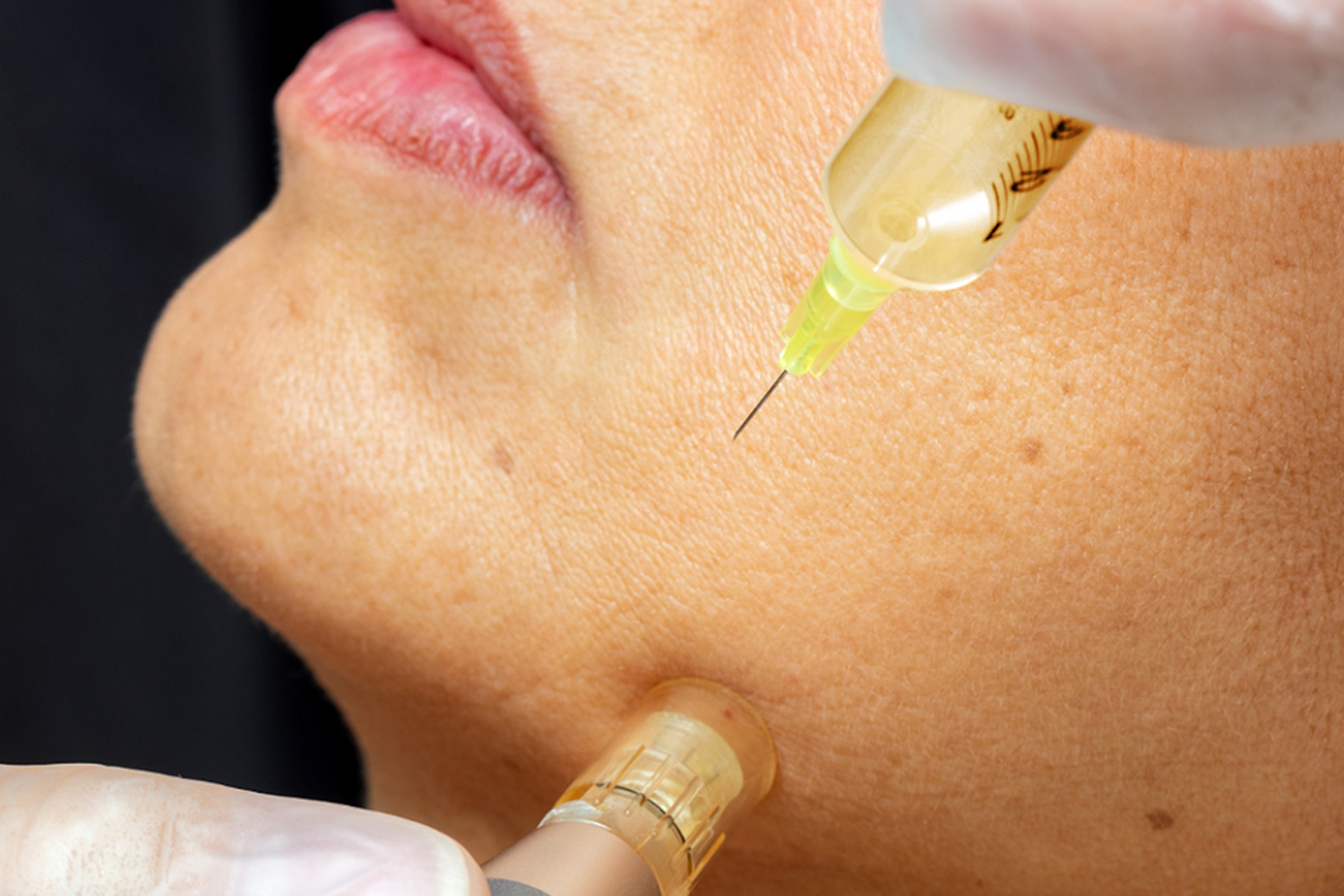 Micro Needling 05